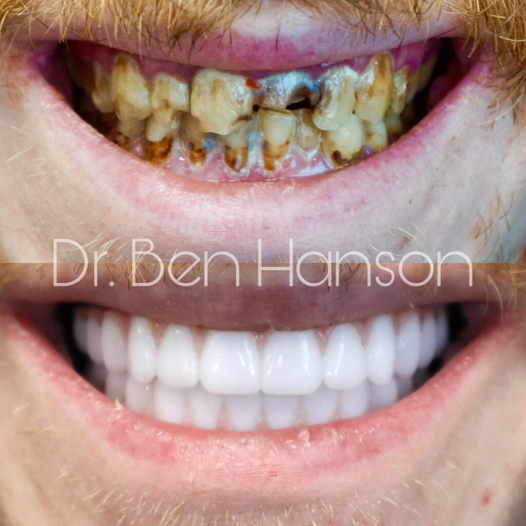 Before & After Dental Implant Treatment