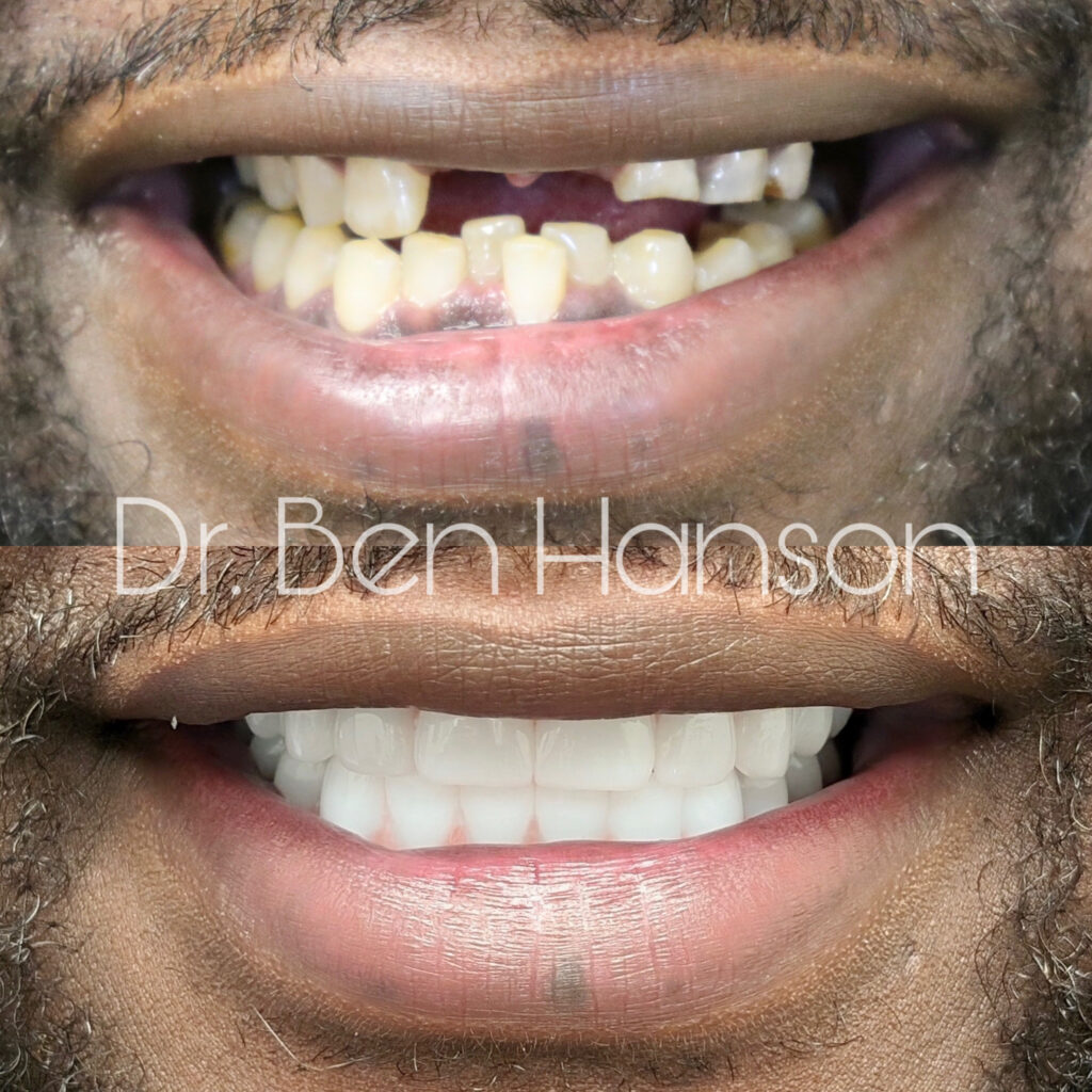 Before & After Dental Implant Treatment