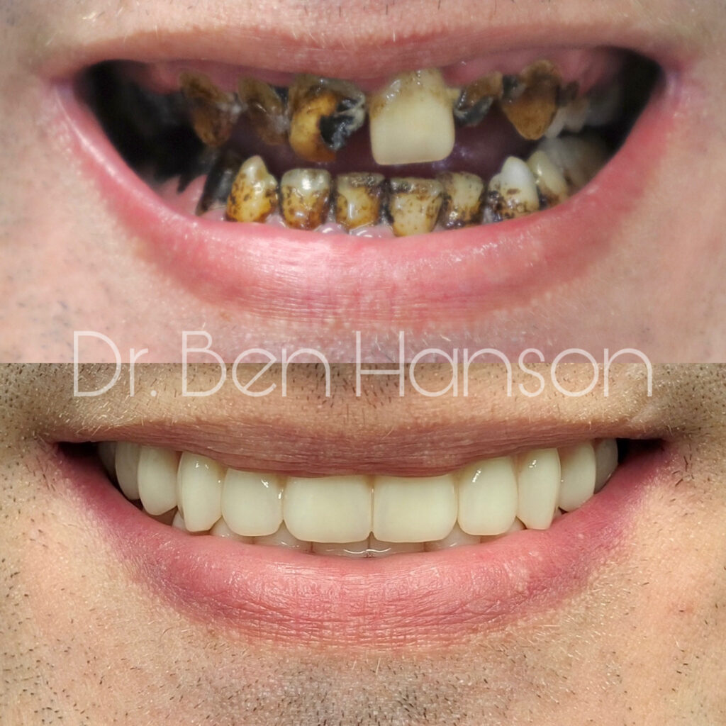 Before & After Dental Implant Treatment